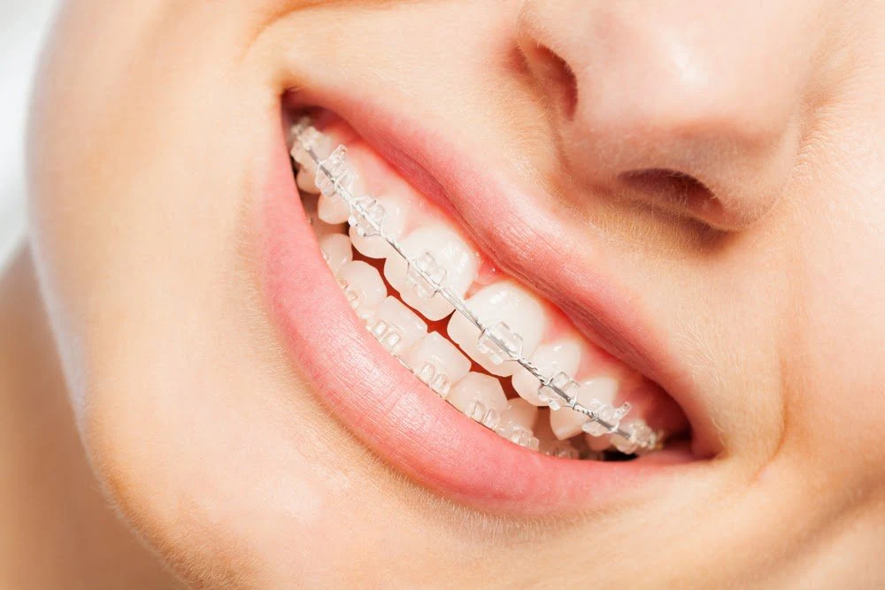 Ceramic Braces - Image 3