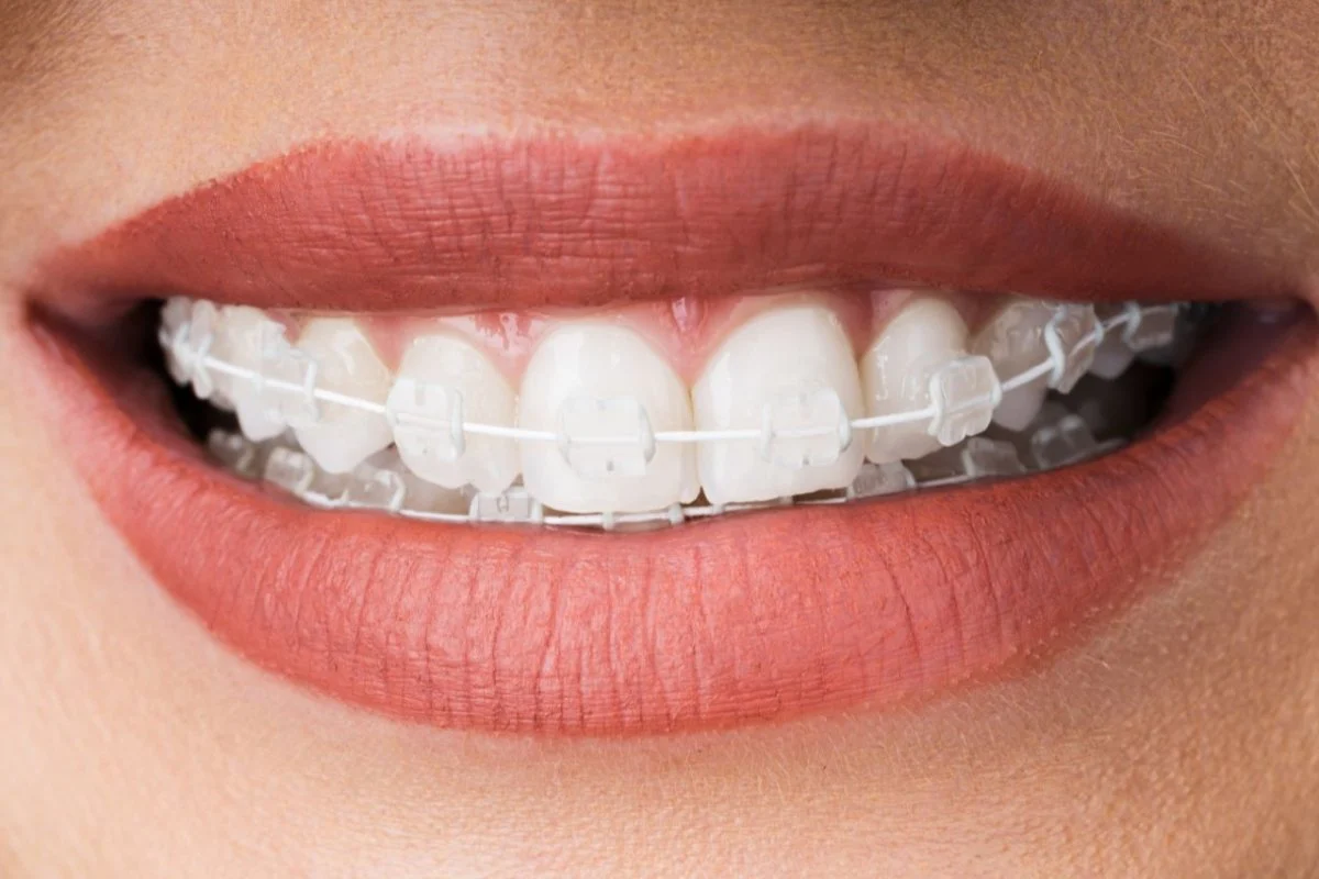 Ceramic Braces - Image 5
