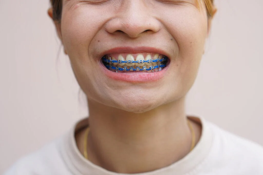 Metal Braces - Image 3