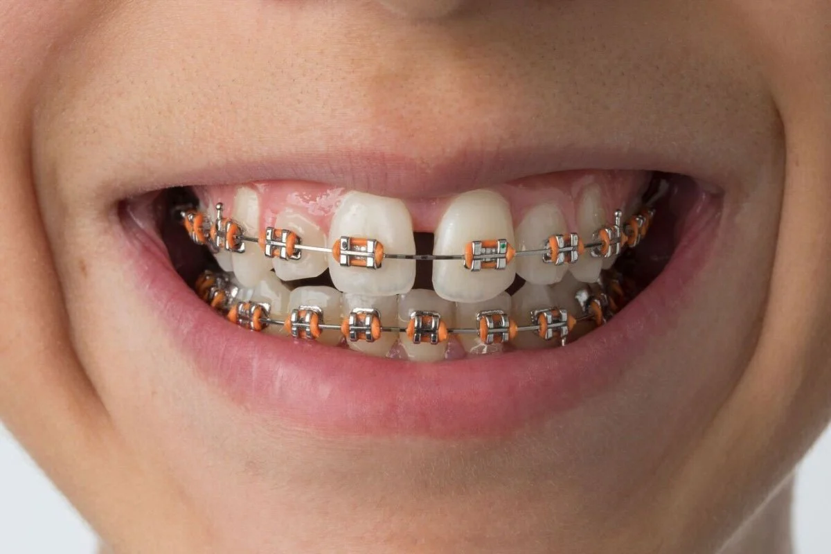 Metal Braces - Image 5